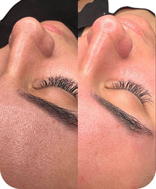 Hydrafacial