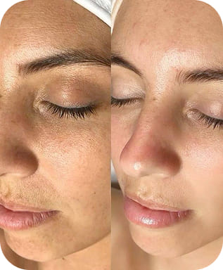 Hydrafacial